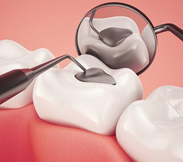 ترمیم پوسیدگی دندان با آمالگام
