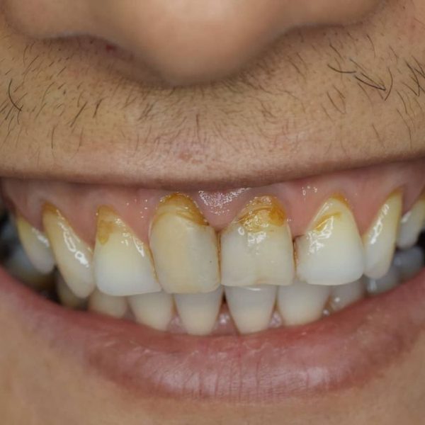 before-composite