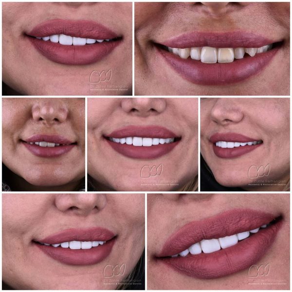 before-after-composite