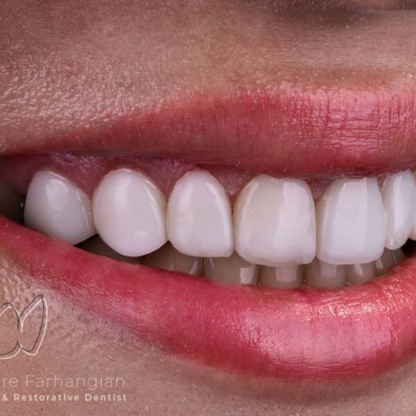 before-after-composite