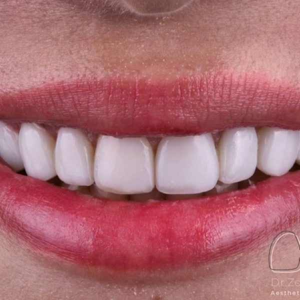 before-after-composite