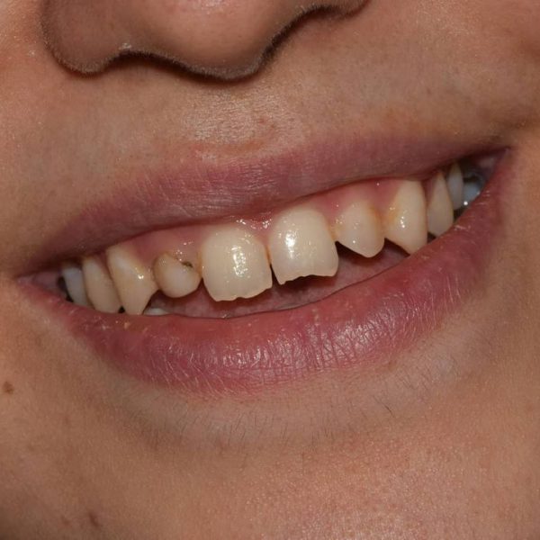 before-composite