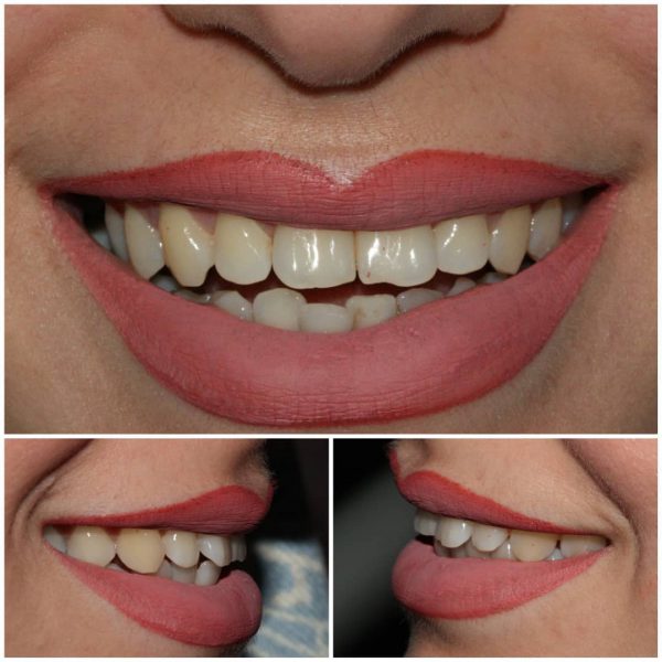 before-composite