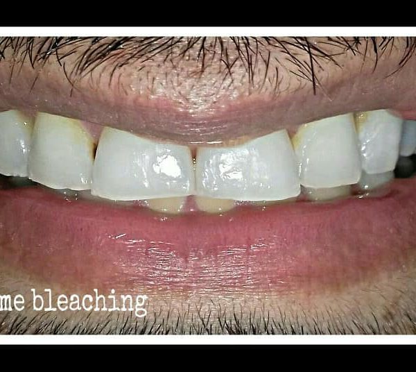 نمای بعد از بلیچینگ