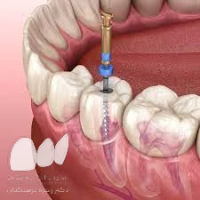 عصب کشی دندان کرمانشاه