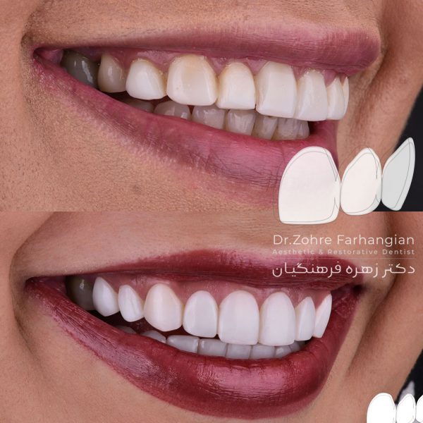 کامپوزیت ونیر فک بالا و پایین کرمانشاه