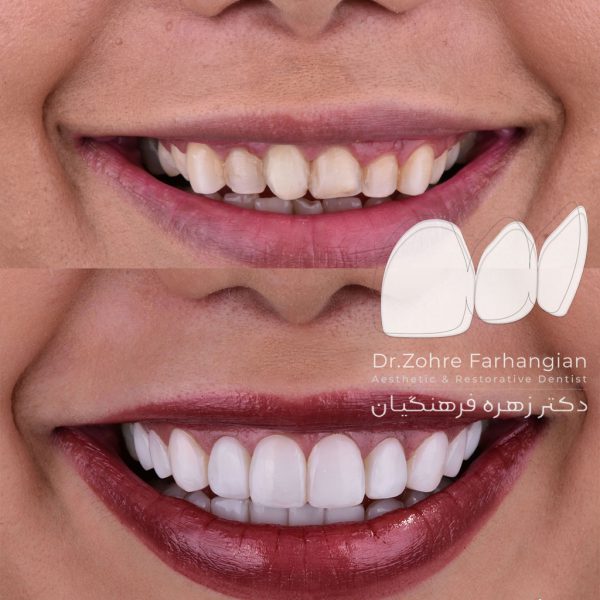 کامپوزیت ونیر فک بالا و پایین