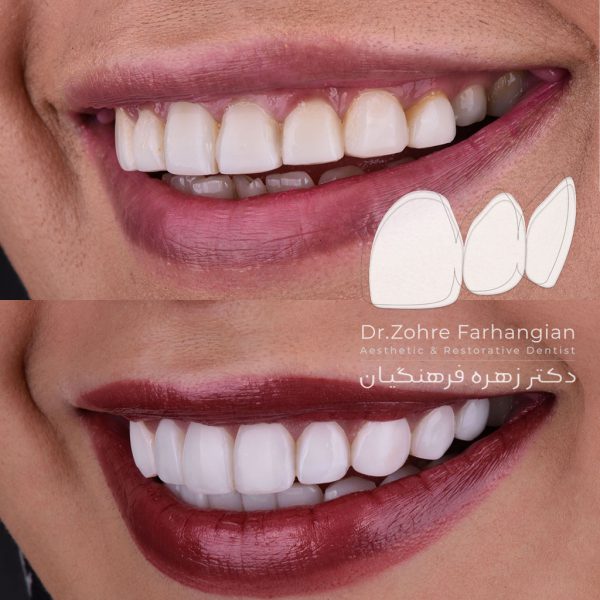 کامپوزیت ونیر فک بالا و پایین